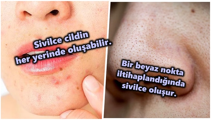 Ergenliğe Girdiğimizden Beri Bir Türlü Peşimizi Bırakmayan Sivilce ve Siyah Noktaların Arasındaki Farklar