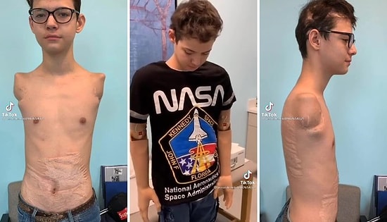 Robotik Protez Kollar Sayesinde Bir Şeylere Dokunabilen Çocuğun O Anlarını İzlerken Gününüz Güzelleşecek