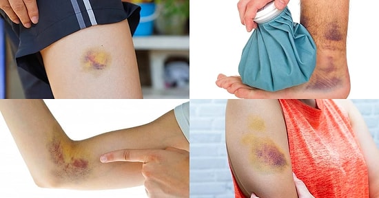 Cildimizdeki Morarmalar Neden Oluşur?