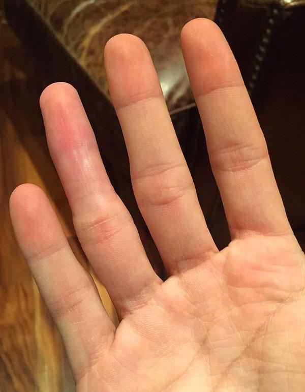 15. "Parmağım kırıldığı için uzun bir süre atel taktım ve şimdi yüzük parmağımdaki eklemin bükülme çizgisi kayboldu."