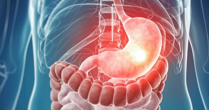 Gastrit Nedir, Belirtileri Nelerdir? Tanı ve Tedavisi Nasıl Yapılır?