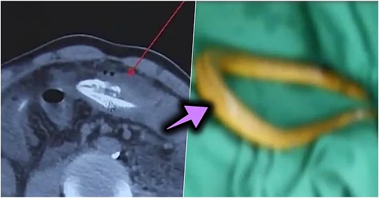 Kabızlık Sorununu Poposuna Yılan Balığı Sokarak Çözmeye Çalışan Adamın Bi' Garip Hikâyesi