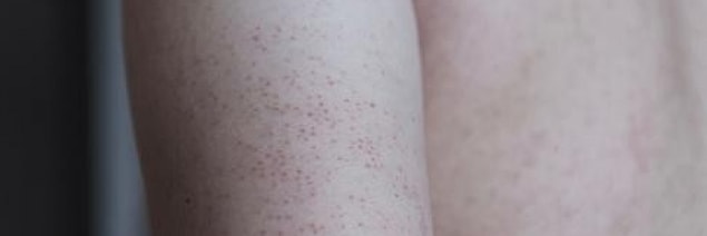 11. Keratosis pilaris