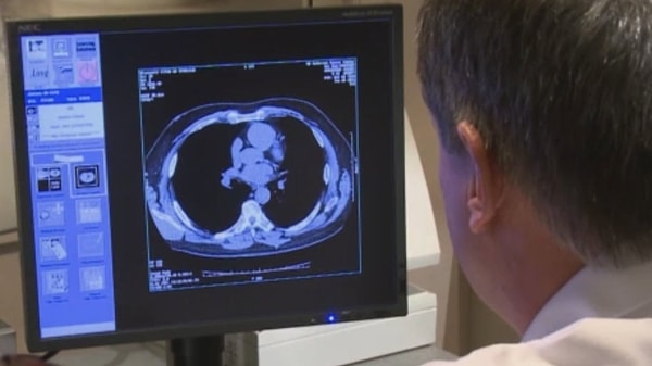 Yaklaşık 600 akciğer kanseri teşhisi konulmuş hastaya verilecek