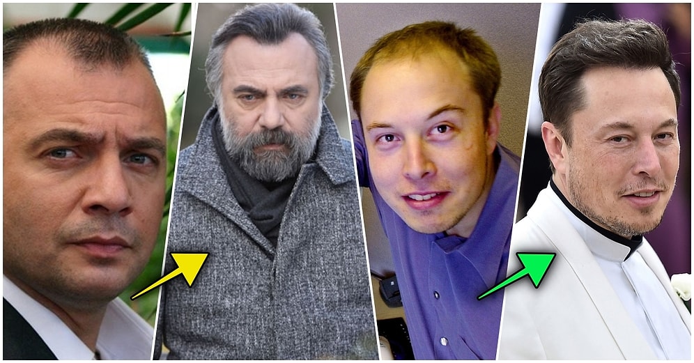 Oyunculardan Futbolculara! 'Benim Başım Kel mi?' Diyerek Saç Ektirmeye Karar Veren 16 Ünlü İsim