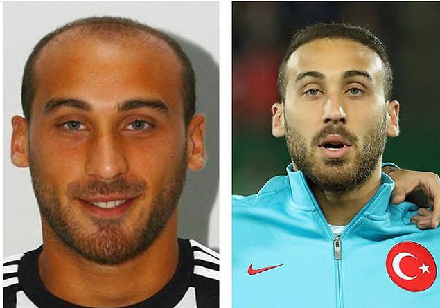13. Everton takımında forma giyen milli futbolcumuz Cenk Tosun da saç ektirme kervanına katılmış.