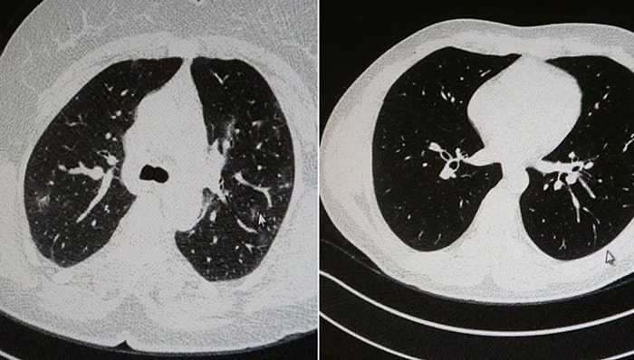 Görüntüler Korkutucu: Aşılı ve Aşısız Olarak Koronavirüse Yakalanan 2 Gencin Akciğer Tomografisi