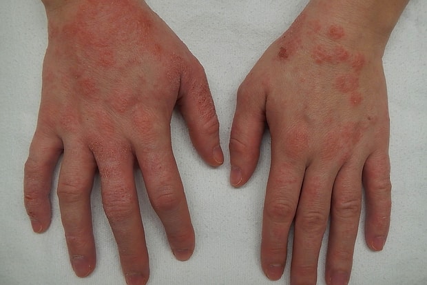 egzama nedir belirtileri nelerdir egzama tedavisi nasil yapilir egzama nedir belirtileri nelerdir egzama tedavisi nasil yapilir