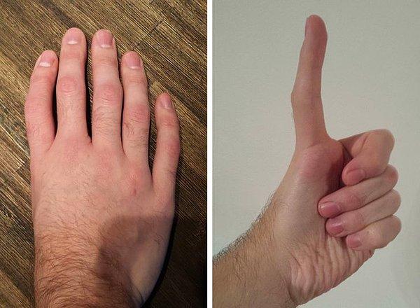 1. Sağ elinde beş adet parmağı olduğu halde baş parmağı bulunmayan bu adamın sol elinde upuzun bir baş parmağı var !