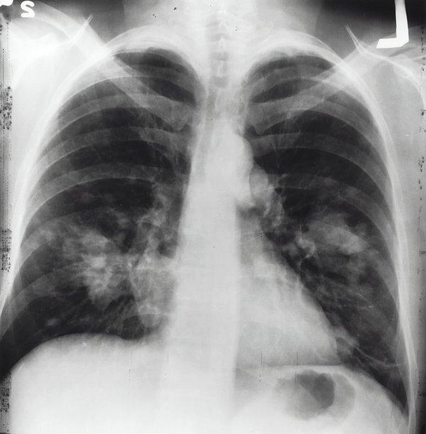 1. Yetişkin bir bireyin akciğerlerinin yüzeyi yaklaşık olarak 70 metrekaredir.