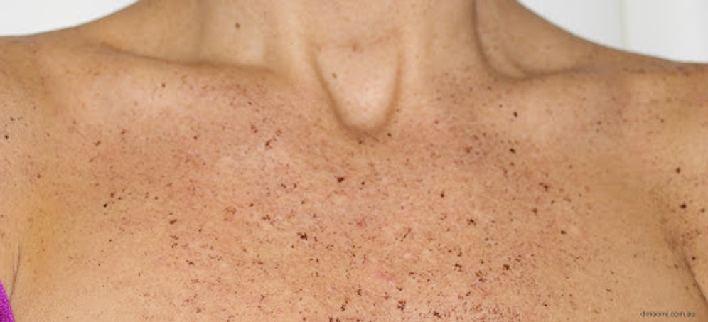 Güneş Lekesi Nedir? Nasıl Geçer?