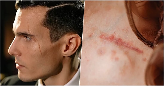 Hücrelerimiz Kendilerini Yenilemelerine Rağmen Yara İzlerimiz Neden Geçmez?