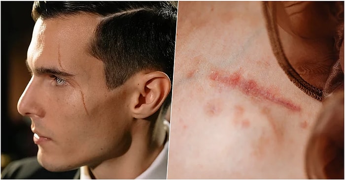 Hücrelerimiz Kendilerini Yenilemelerine Rağmen Yara İzlerimiz Neden Geçmez?