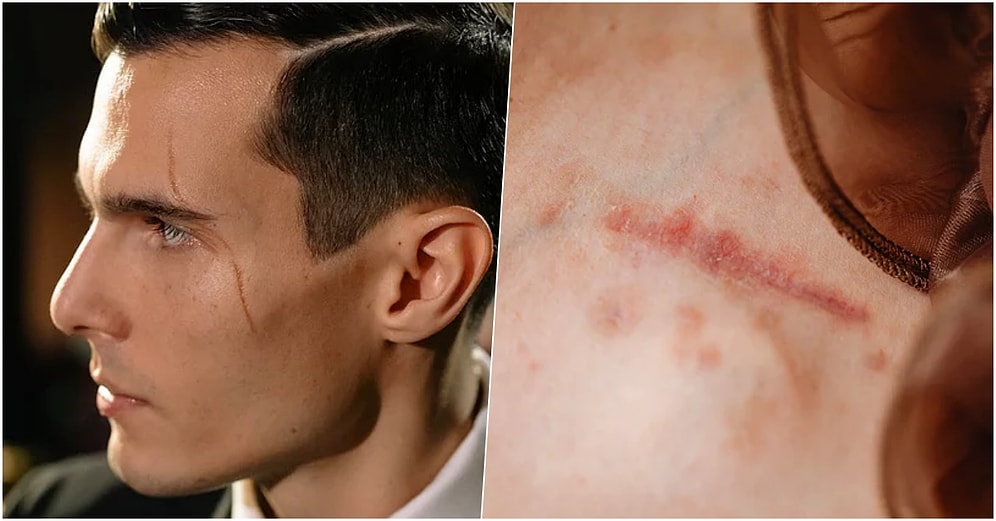 Hücrelerimiz Kendilerini Yenilemelerine Rağmen Yara İzlerimiz Neden Geçmez?