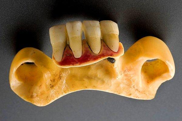 11. Takma dişler gerçek dişlerden yapılıyordu.