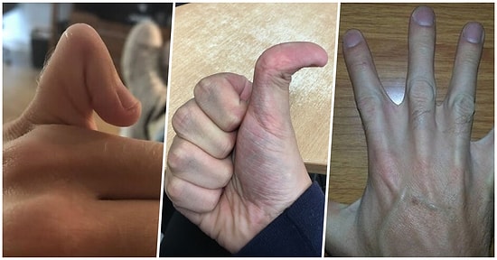 Vücutlarında Taşıdıkları Garip Farklılıklarla Herkesi Şaşırtan 15 Kişi