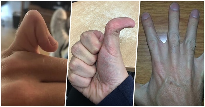 Vücutlarında Taşıdıkları Garip Farklılıklarla Herkesi Şaşırtan 15 Kişi