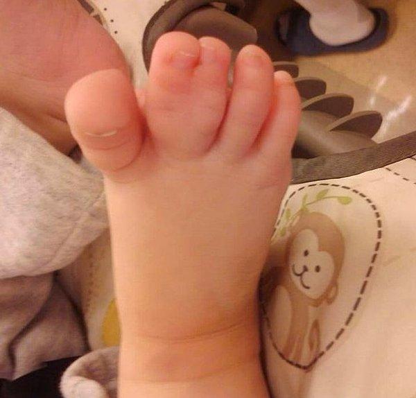 2. Her 2000-3000 bebekten biri yapışık parmak ile doğar.