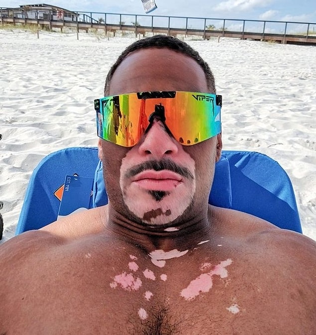 3. "Vitiligo hastalığı benzersiz lekeler oluşturuyor."