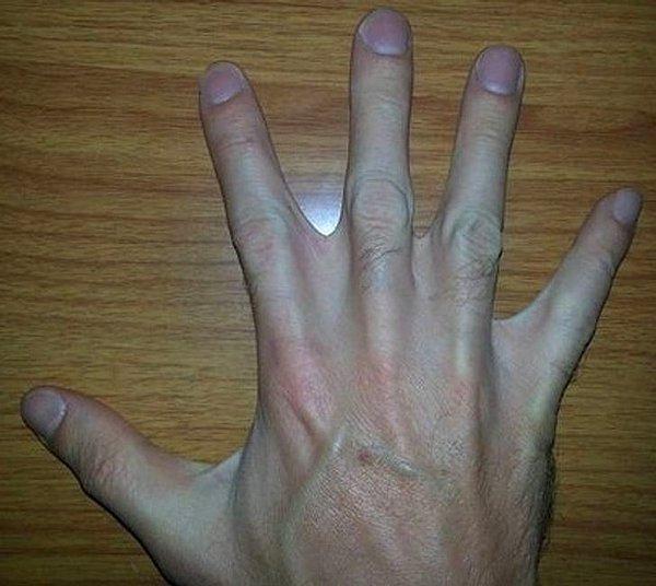 15. "Perdeli parmaklarım doğumsal bir bozukluk olarak vücudumda yer alıyor."