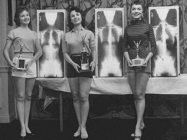 10. 1950’li yıllarda Amerika Birleşik Devletleri, Chicago’da en iyi omurganın seçildiği bir ortopedi konferansı: