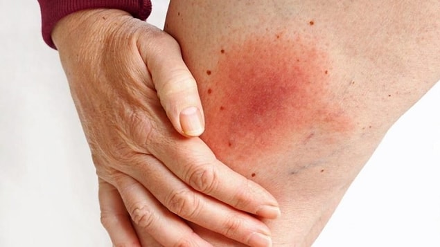 Lyme Hastalığı İçin Hangi Bölüme/Doktora Gidlir?