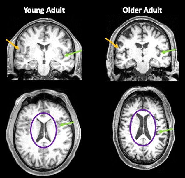 Araştırmacılar, 35 yaşındaki bir insanla 80 yaşında bir insanın beyinlerini karşılaştırdı.