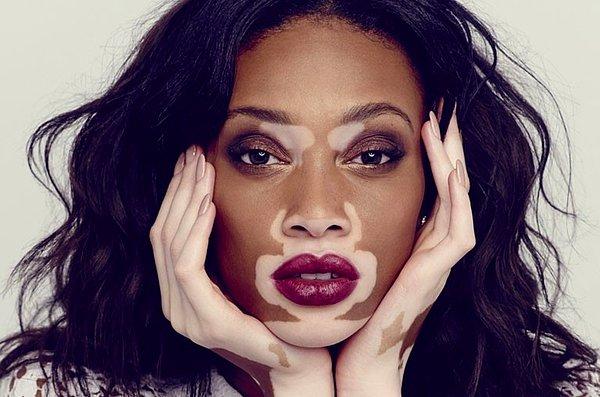 23. Bir diğer nadir özellik 'ala hastalığı' olarak bilinen vitiligo, nüfusun %1'inden az insanda bulunuyor.