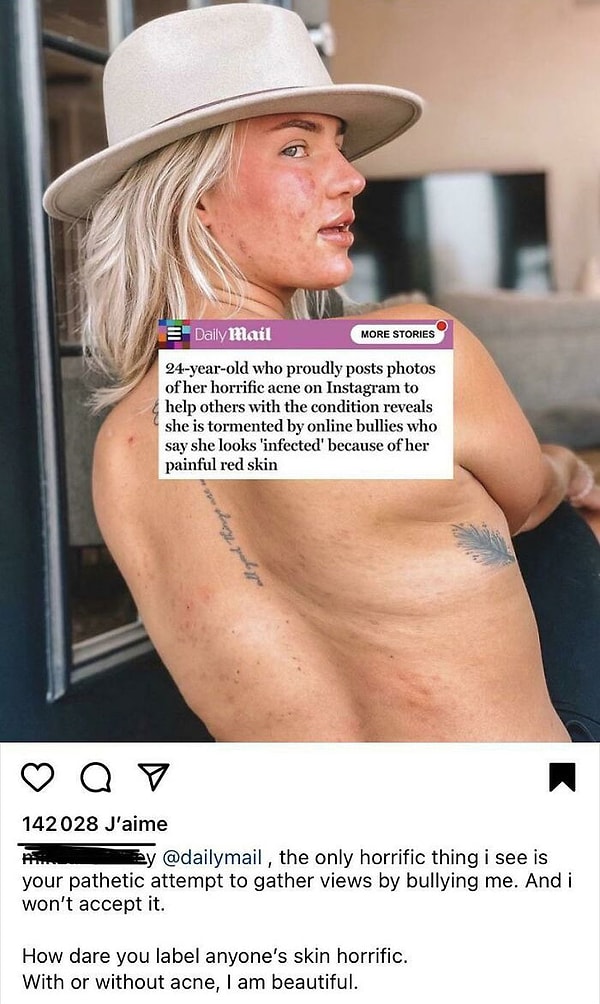1. 24-летняя девушка с акне гордо продемонстрировала свое тело в Инстаграм