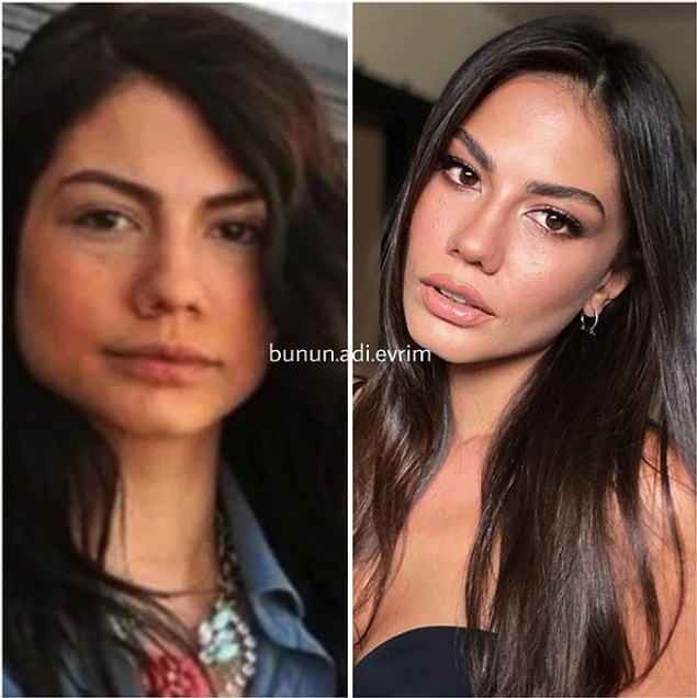 3. Demet Özdemir'in yüz şeklindeki değişimi artık bilmeyen yok. Merak edenler varsa söyleyelim, Masseter botoks müdahalesi var!