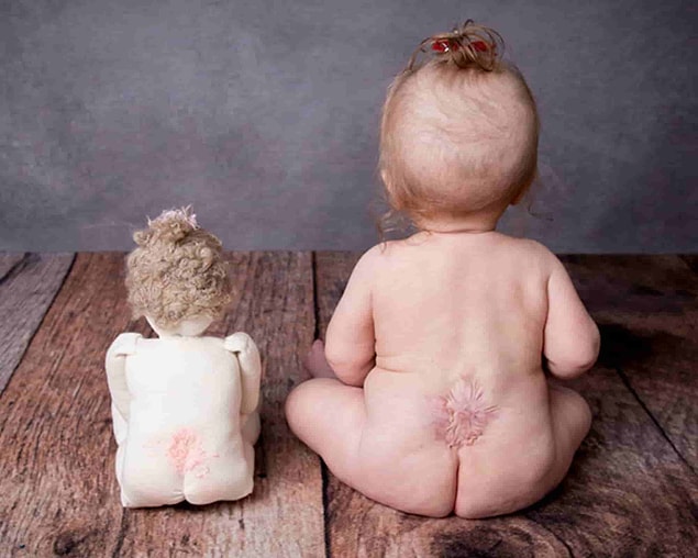 Spina Bifida Belirtileri Nelerdir?