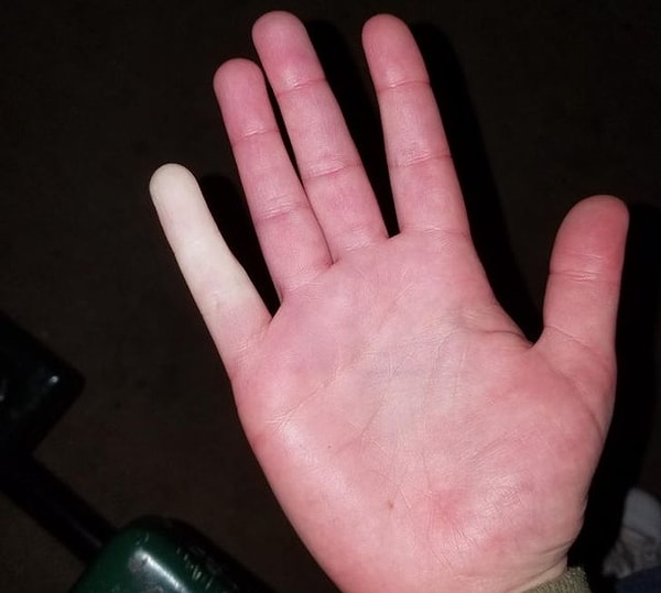 13. "Raynaud Sendromuna sahibim, bu yüzden hava soğuduğunda bazen parmaklarım renk değiştiriyor."