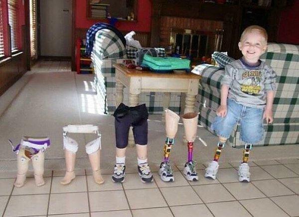 11. Bir yetişkin tek bir protez bacak ile yaşayabilirken, bir çocuk birden fazlasına ihtiyaç duyar.