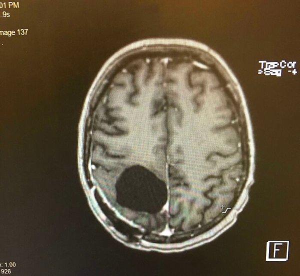 12. "Beyin tümörümü aldırdım. Ve şimdi beynimin bir kısmı yok."