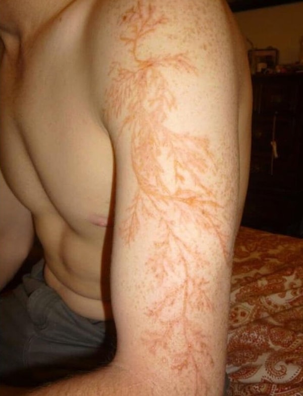 12. Выживший после удара молнии