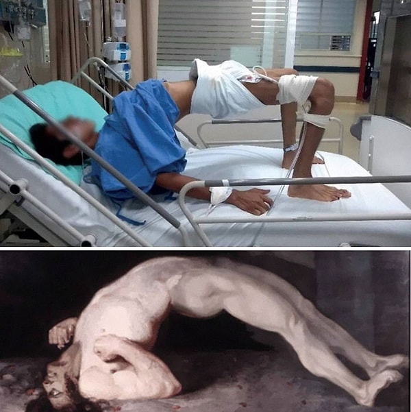 9. Случай столбняка у непривитого ребенка