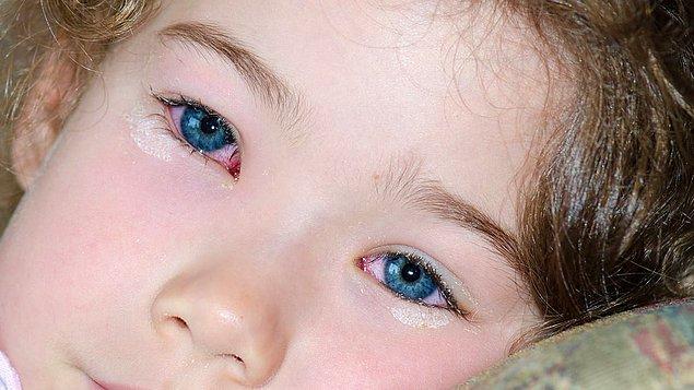 Bebeklerde Göz Çapaklanması Neden Olur?
