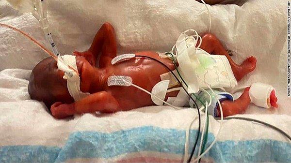 Curtis Means adlı bu minik bebek, 420 gramlık doğarak, çok erken doğduğu halde hayatta kalmayı başarmış ilk prematüre bebek oldu.