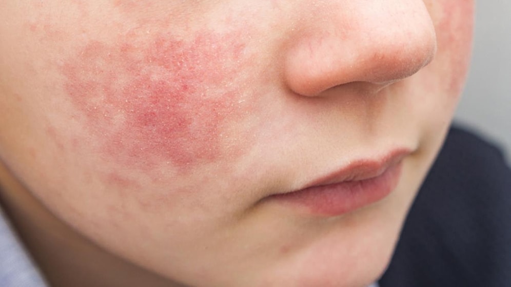 Beşinci Hastalık Nedir? Belirtileri ve Tedavisi…