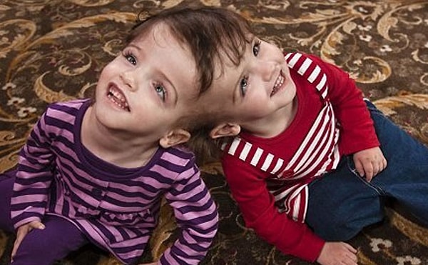 6. Эти сиамские сестры-близнецы на самом деле имеют общий мозг, но не только это, они могут слышать мысли друг друга и видеть друг друга глазами