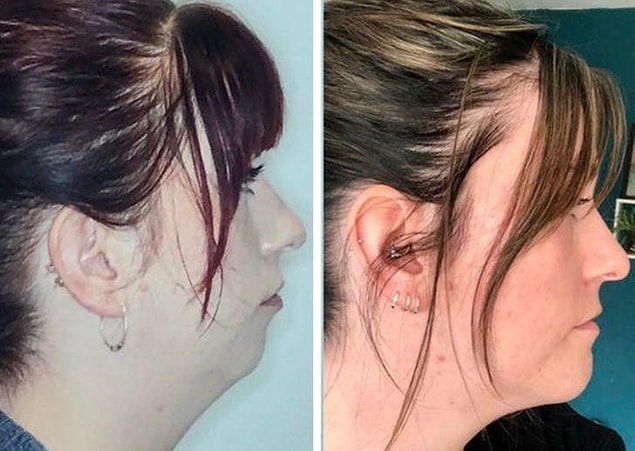 3. "11 months after surgery"