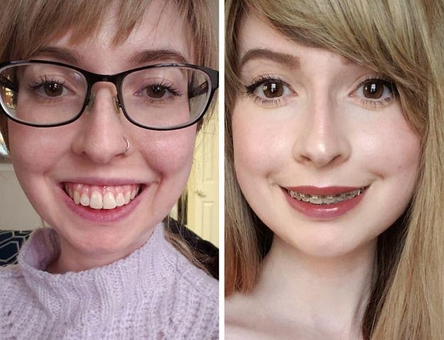 6. "20 days after upper jaw surgery"