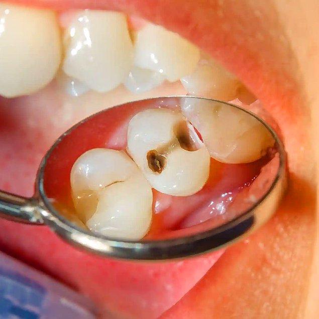 Diş Çürüğü Belirtileri Nelerdir?