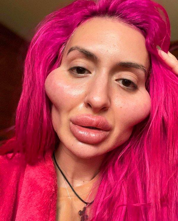 30 yaşındaki Anastasia Pokreshchuk "dünyanın en büyük elmacık kemikli yanaklarına" sahip.