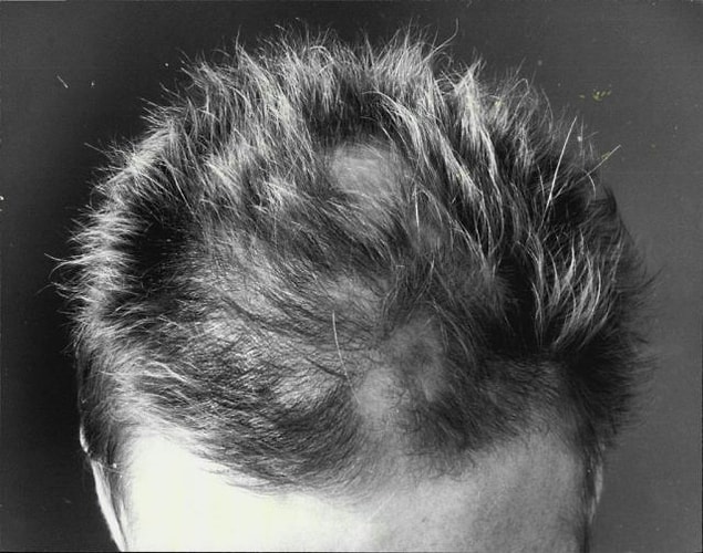 15. Saç dökülmesinin en büyük yavaşlatıcısı ve saç çıkmasına da destek olan, saç bakım ürünlerinin ana bileşenlerinden minoxidil, başlangıçta hipertansiyonun tedavisinde kullanılan bir ilaçtı!