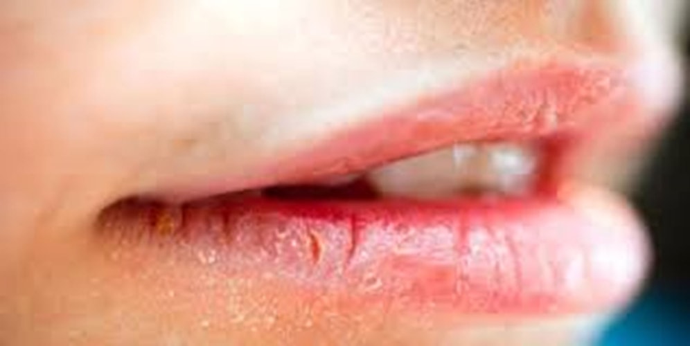 Dudak Kuruması ve Çatlaması Nasıl Geçer?