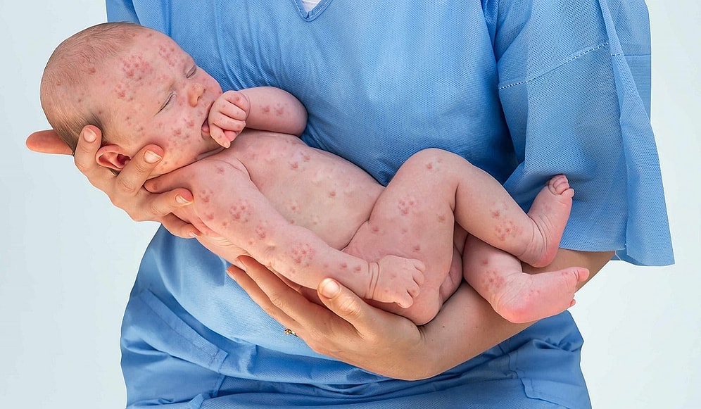 Kızamık Nedir? Belirtileri ve Tedavisi…