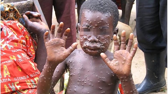 Kongo'da Maymun Çiçeği Salgını: 24 Kişi Öldü