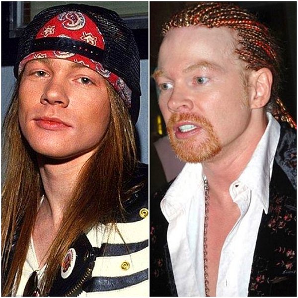 2. Guns N' Roses grubunun solisti Axl Rose, yüzünü gerdirmiş ve yanak implantı yaptırmış.