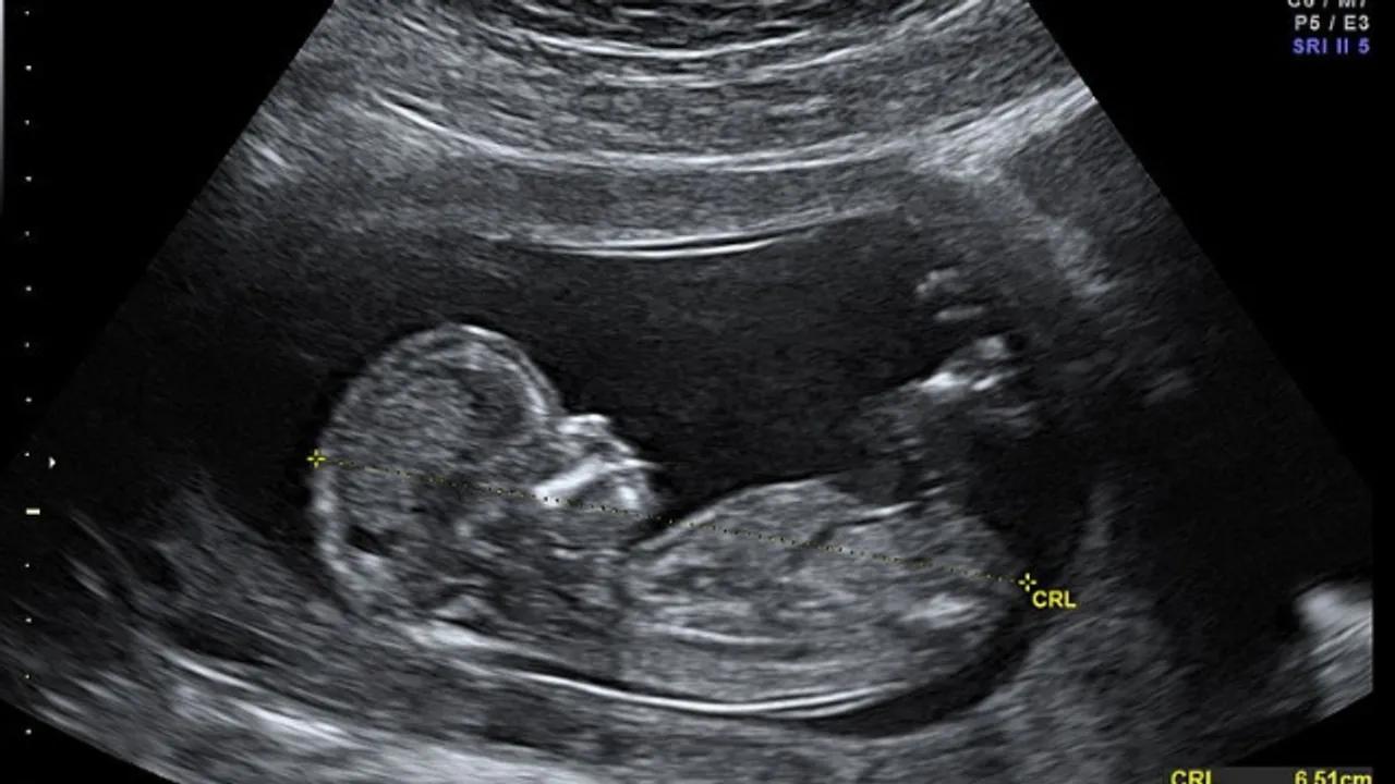 karindan ultrasonda bebek ne zaman gorulur bebek battaniyesi